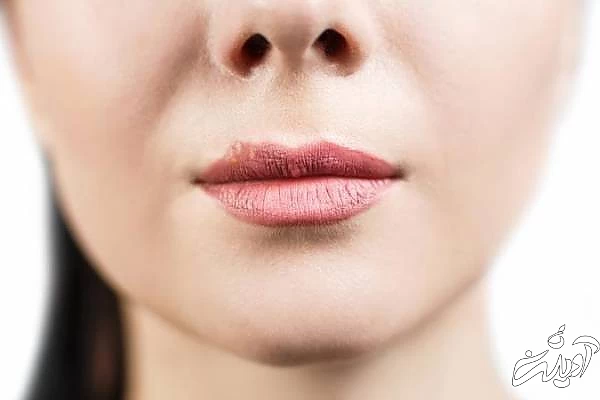 درمان تبخال لب